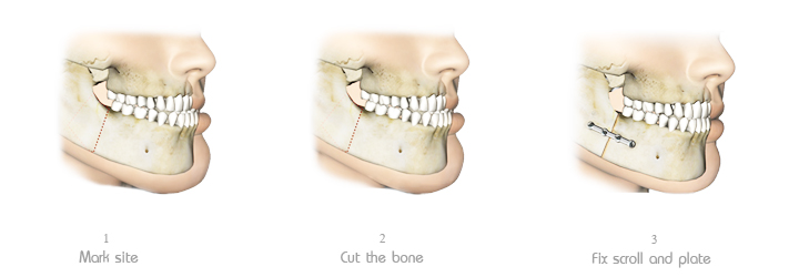 Lower Jaw Backward Surgery