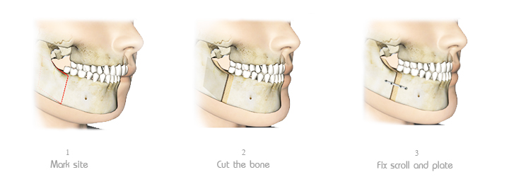 Lower Jaw forward Surgery