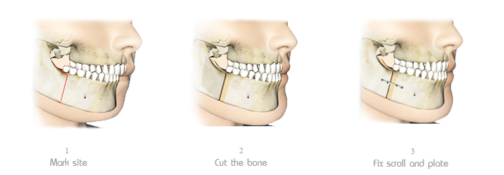 Lower_Jaw_forward_Surgery