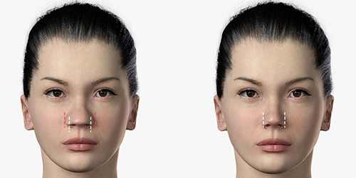 แสดงภาพก่อนหลัง การแก้ไขปลายจมูก (  Nose Tip Correction )