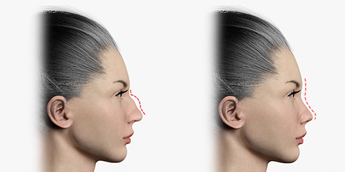 Antes e depois: rinoplastia de redução de corcova nasal