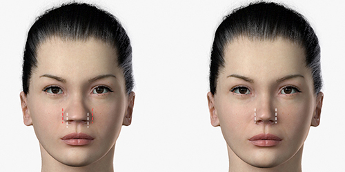 Antes e depois: Rinoplastia de correção de ponta nasal