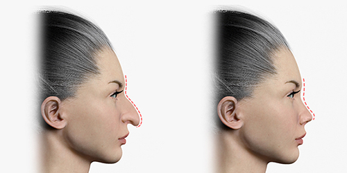 Antes e depois: Rinoplastia de correção de ponta nasal caída