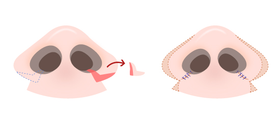  Antes e depois: Rinoplastia - Alarplastia