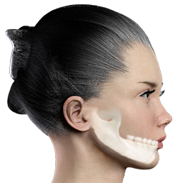 Jaw Augmentation, Jaw Implant, Mandibular Augmentation