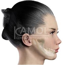 Shows before and after surgery jaw augmentation