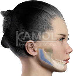 Shows before and after surgery jaw augmentation