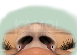 The Area to Be Removed to Decrease the Nostrils Size