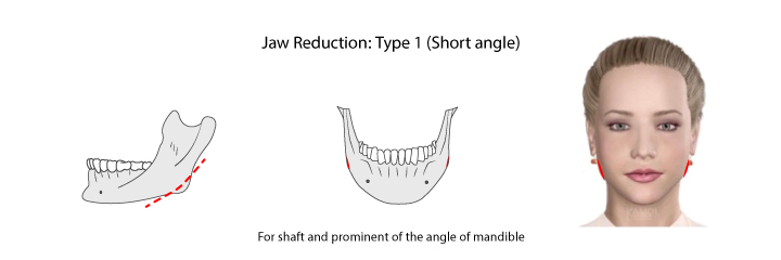 Shows Jaws reduction type 1: the shaft and prominent of the angle of the jaw.