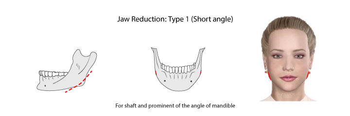 Jaws_reduction_type_1_Short_angle.