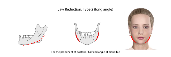 jaw_Reduction_Tpye_2_long_angle