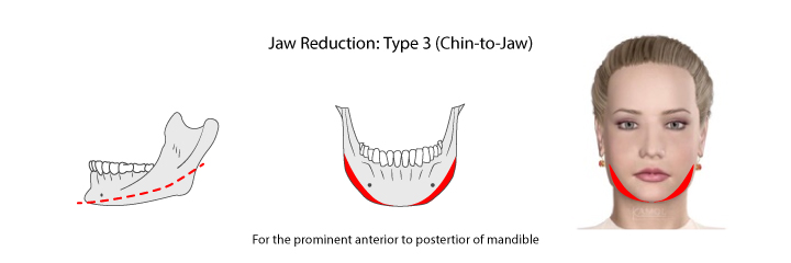 jaw_Reduction_Type_3_Chin_to_jaw