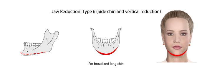 Jaw_reduction_type_6:_side_chin_and_vertical_reduction. 