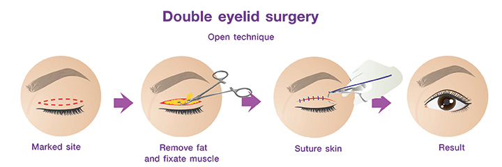 Shows the procedure for Double eyelid surgery by open technique.