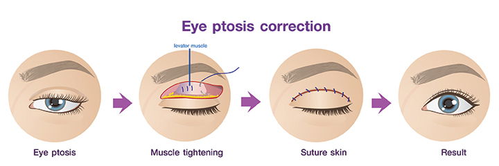Shows the eye ptosis correction procedure.