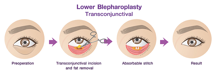 Shows the transconjunctival lower eyelid surgery procedure