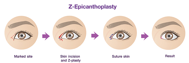 Shows Z- Epicantoplasty procedure