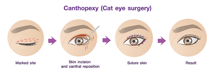 Shows Canthopexy ( Cat eye surgery) procedures.