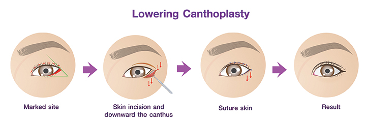 Shows Lowering Canthoplasty procedures.