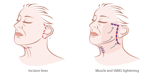 Shows neck lift and neck tuck procedures