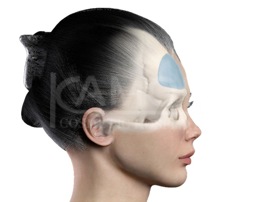 Positioning of Material for Forehead Implant