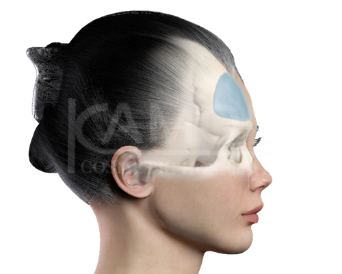 Positioning_of_Material_for_Forehead_Implant