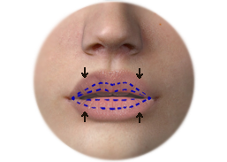 Incision_line_and_the_result_of_lip_reduction.