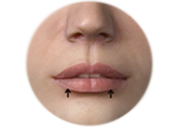 Shows the incision line and the result of lip reduction.