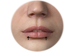 Incision_line_and_the_result_of_lip_reduction.