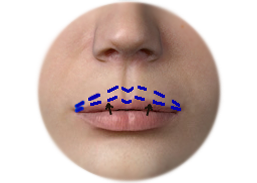 Shows Upper lip lift incision with direct lip technique.