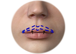 Upper_lip_lift_incision_with_direct_lip_technique.