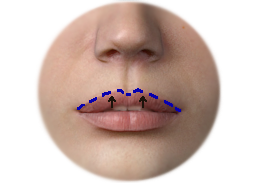 Shows Upper lip lift incision with direct lip technique.