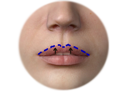 Upper_lip_lift_incision_with_direct_lip_technique.