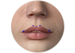 Shows Cupid bow lip enhancement by Acellular dermal matrix augmentation