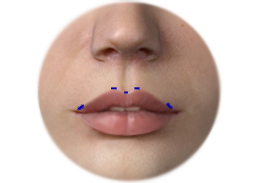 Cupid_bow_lip_enhancement_by_Acellular_dermal_matrix_augmentation