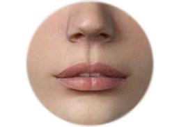 Philtrum_enhancement_with_augmentation