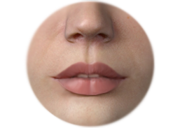 Lips_Enhancement_by_filler_injection