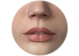 Shows Lips Enhancement by Fat Graft