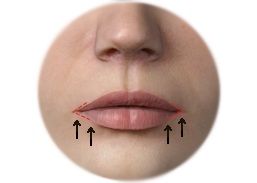 Shows the incisions and results of Lip surgery by Corner Lip Lift