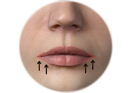 Incisions_and_results_of_Lip_surgery_by_Corner_Lip_Lift