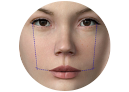 Incision_and_result_of_a_dimples_surgery