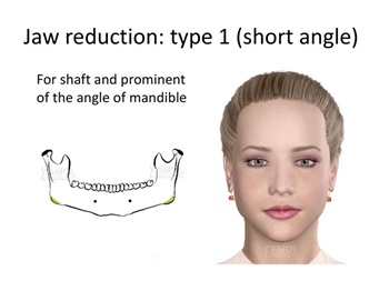 Type 1 : short angle – jaw reduction, for prominent of mandibular angle