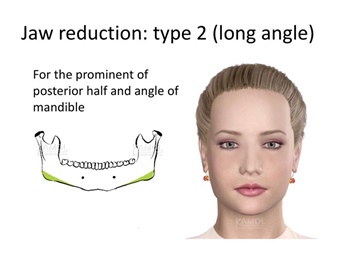 Type 2 : long angle resection, for the prominent of posterior half and angle of mandible