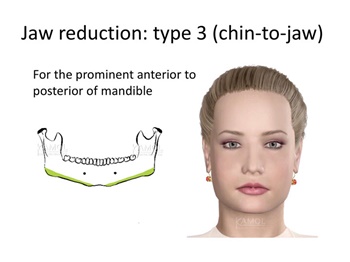 Type 3 : Chin-to-jaw resection, for the entire prominent of mandible