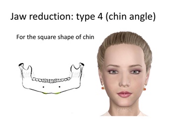 Type 4 : Side chin shaving, for the square shape of chin