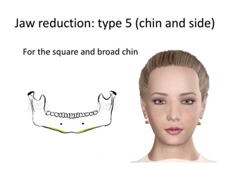 Type 5: Chin and side resection, for the square and broad chin