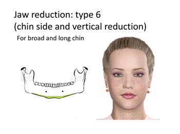 Type 6: Chin-Side and  vertical reduction, for broad and long chin