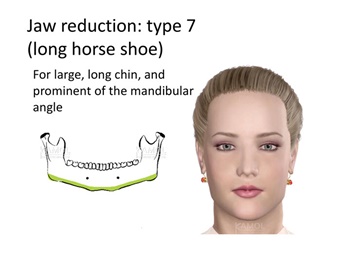 Type 7: Chin-to-jaw and  vertical resection, for large jaw and long chin