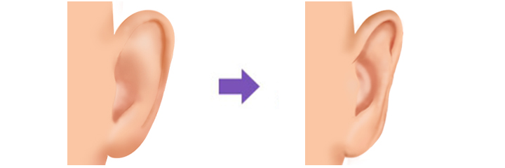 Otoplasty Bat Ear Cosmetic Plastic Surgery Aesthetic Surgeons Bangkok Thailand