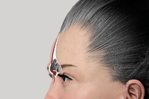 แสดงกระดูกไซนัสด้านหน้า หนา สามารถปรับความโค้งหน้าผากได้ โดยใช้เทคนิค กรอหน้าผาก (Forehead  Shaving)